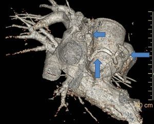 A fistulized artery originating from the right coronary artery 2 cm distal to the orifice and draining into the inferior vena cava at the intersection with the proximal atrium after following a tortuous course, as demonstrated by reformatted three-dimensional volume rendered computed tomography angiographic imaging.