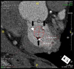 Measurement of the internal diameter between the stent posts (arrows) of the previously implanted mitral bioprosthesis.