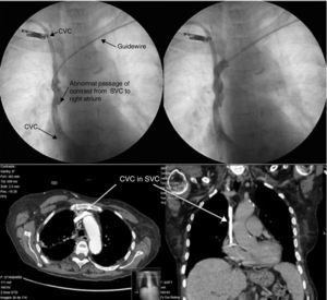 Permanent pacemaker implantation using a femoral approach | Revista ...