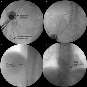 Fluoroscopy images during placement of a single-chamber permanent pacemaker via the right femoral vein in patient A.A. A Relia SR pacemaker (Medtronic®) in VVI mode was implanted, with an 85-cm lead. (A) Site of lead insertion in the femoral vein and position of the generator in the right flank; (B and C) course of the lead up to the apex of the RV; (D) lead positioned in the RV. IVC: inferior vena cava; RV: right ventricle.