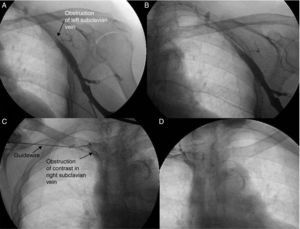 Fluoroscopy images during attempts at pacemaker implantation in the second patient, H.P., via the left cephalic and right subclavian veins, without success. Contrast administration showed obstruction of the left (A and B) and right subclavian veins (C and D).