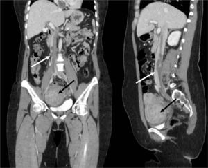 Enhanced computed tomography scan. Coronal (left) and sagittal (right) sections showing a filling defect image extending from the right atrium through the inferior vena cava (white arrow). A well-defined tumor arises from the uterus (black arrow).