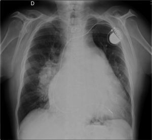 Chest X-ray showing cardiothoracic ratio of >50%, dilatation of the right atrium and of both pulmonary arteries, and pulmonary vasculature enhancement.