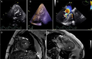 (A) Two-dimensional transthoracic echocardiography, apical 4-chamber view, showing several nodular hyperechogenic masses with acoustic shadowing in the mid-left ventricular cavity (arrows); (B) three-dimensional transthoracic echocardiography, left ventricular full-volume view depicting all of the nodular masses within the left ventricular cavity (arrows); (C) two-dimensional Doppler color flow transesophageal echocardiography, mid-esophageal 3-chamber view with turbulent flow across the mid-left ventricular cavity; (D and E) steady-state free precession cine cardiac magnetic resonance, short-axis and 3-chamber long-axis views with a hypointense linear structure inside the left ventricle (arrowheads). LA: left atrium; LV: left ventricle; LVOT: left ventricular outflow tract; RV: right ventricle.