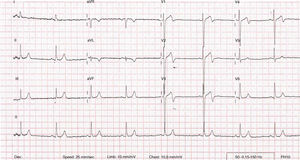12-lead electrocardiogram showing T-wave inversion in leads AVL and V1–V4.