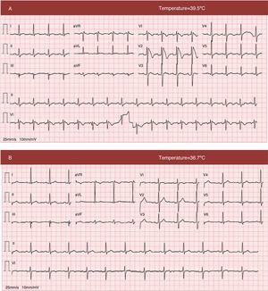 12-lead electrocardiogram (A) at admission with fever, showing sinus rhythm at 100 bpm, coved ST-segment elevation in V1 and V2, maximum 0.6 mV in V2, followed by a negative T wave, compatible with type 1 Brugada pattern; QTc is 412 ms; (B) electrocardiogram in apyrexia, showing resolution of the alterations in ventricular repolarization seen in V1 and V2.