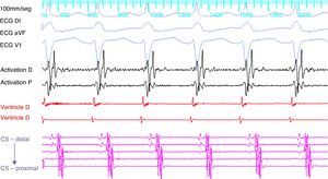 Paroxysmal supraventricular tachycardia with eccentric retrograde activation and atrial activation earlier at the distal electrodes of the coronary sinus. At this point the ablation catheter is in the left ventricle. CS: coronary sinus.