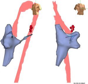 Left and right oblique views showing the geometry of the right atrium, right ventricle, coronary sinus and aorta used to position the ablation catheter. The geometry of the left ventricle was not recreated, the geometry of the coronary sinus being used to guide the catheter. The red points indicate the sites with earliest activation for radiofrequency application.