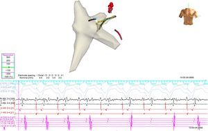 Ablation catheter positioned in the left lateral region; retrograde conduction has been terminated after radiofrequency (RF) application. The geometry illustrated is of the right atrium, right ventricle and coronary sinus. Red spheres indicate the region where RF application terminated accessory pathway conduction.