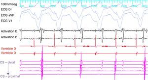Ventricular pacing in the right ventricle shows ventriculoatrial dissociation at the end of the procedure, demonstrating abolition of retrograde conduction via the accessory pathway.