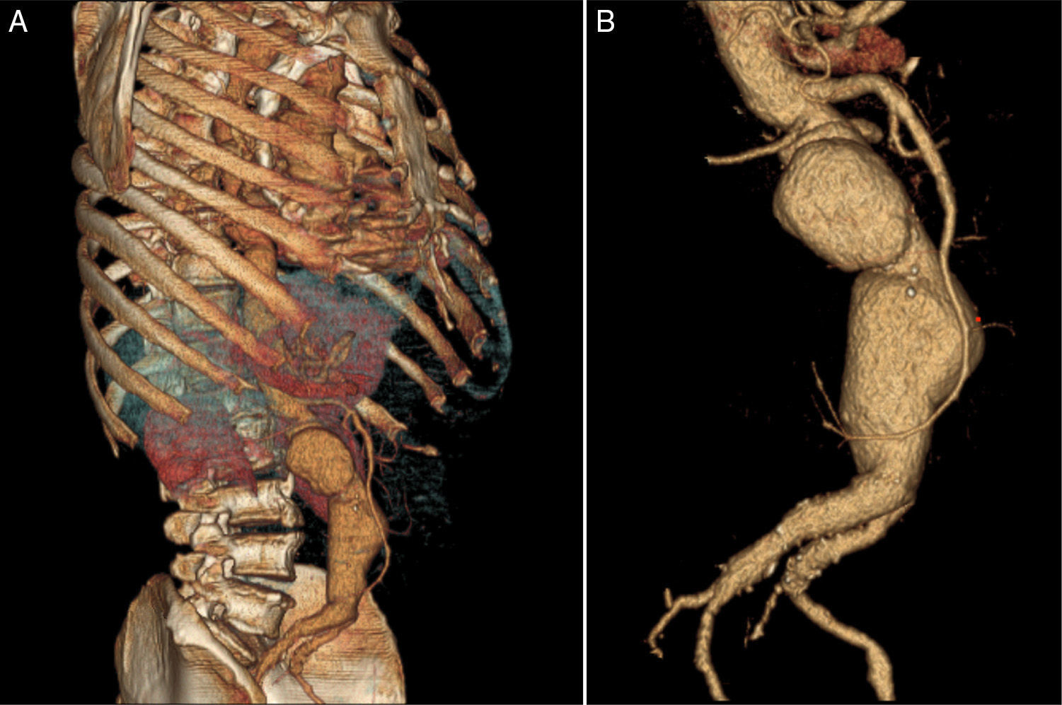 Abdominal aortic aneurysm – Characterization by three-dimensional ...