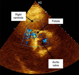 Transthoracic echocardiography, parasternal short-axis view with color Doppler, demonstrating an aortic intimal flap and turbulent flow from the aortic root toward the right ventricle.