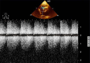 Continuous Doppler echocardiography showing continuous flow between the aortic root and right ventricle.