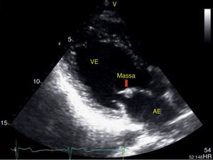 Ecocardiograma transtorácico em paraesternal longitudinal onde se visualiza pequena massa bem definida aderente ao folheto anterior da válvula mitral. AE: aurícula esquerda; VE: ventrículo esquerdo.