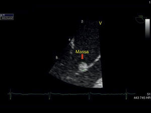 Ecocardiograma transesofágico em corte longitudinal com ampliação da zona de interesse com a massa ecodensa, de 0,5 cm2 aderente ao folheto anterior da válvula mitral. AE: aurícula esquerda; VE: ventrículo esquerdo.