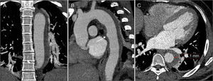 Control CTA on the eighth day, showing a slight increase in hematoma thickness to 15 mm and a crescent-shaped formation (C), still extending from the left subclavian artery to the emergence of the renal arteries (A); one of the aortic wall ulcers observed on the initial exam now presenting a deeper and more irregular appearance (arrow) (B).