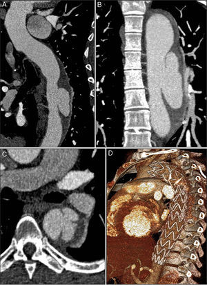 CTA 30 days after discharge, showing evolution of the hematoma to dissection and a pseudoaneurysm measuring 27 mm×51 mm in diameter with a 23-mm neck (A, B and C). The pseudoaneurysm was located in the mid segment of the descending aorta, and intimal rupture originated in the aortic wall ulcer that had shown signs of progression on the second exam; three-dimensional volume reconstruction following thoracic endovascular aneurysm repair, showing two overlapping endoprostheses, from the left subclavian artery to the beginning of the abdominal aorta (D).