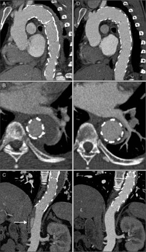 CTA immediately after thoracic endovascular aneurysm repair (A, B and C) and six months after the procedure (D, E and F). The two overlapping aortic endoprostheses can be seen, covering the intramural hematoma and the ductus arteriosus, from the left subclavian artery to the beginning of the abdominal aorta, with no evidence of endoleaks (A); aortic dissection distal to the prosthesis (arrow), originating at the celiac trunk and extending to the superior mesenteric artery (C); compared to the post-procedural exam, at six months almost total regression of the intramural hematoma (D and E) and disappearance of the abdominal aortic dissection (F) can be seen.