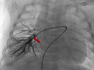 Angiography of the pulmonary artery showing vascularization of the right inferior pulmonary artery branch (red arrow).