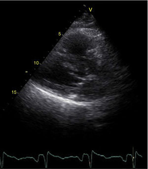 Transthoracic echocardiography in parasternal long-axis view showing morphology of the mitral valve, with limited visualization of the leaflets due to poor image quality but with apparently normal opening.