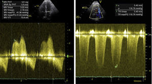 Transthoracic echocardiography: peak transmitral gradient of 41 mmHg and mean of 21 mmHg, and valve area of 1.8 cm2 estimated by the pressure half-time method (left); right ventricle/right atrium gradient of 117 mmHg (right).