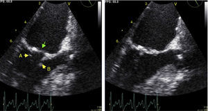 Transesophageal echocardiography (121°) showing morphology of the mitral valve in diastole (left) and systole (right); good opening of the posterior (arrow A) and anterior (arrow B) leaflets can be seen, together with an echogenic structure on the atrial side of the mitral annulus (green arrow).