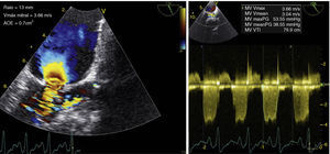 Transesophageal echocardiography (121°): a small convergence zone can be seen (poorly visualized on transthoracic echocardiography), suggesting supravalvular mitral stenosis; effective orifice area of 0.7 cm2 estimated by the proximal isovelocity surface area method (left); peak transmitral gradient of 54 mmHg and mean of 39 mmHg (right).