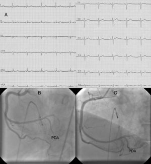 (A) ECG at first admission; (B) right coronary angiography during first myocardial infarction showing total occlusion of the mid portion of the posterior descending artery (PDA); (C) right coronary angiography during first myocardial infarction after percutaneous coronary intervention to the PDA.