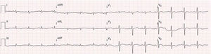 ECG on admission, showing sinus rhythm and low QRS voltage in the classical and limb leads and S1Q3T3 pattern.