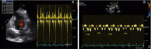 Doppler echocardiogram showing significant respiratory variation in (A) mitral flow and (B) hepatic vein flow.