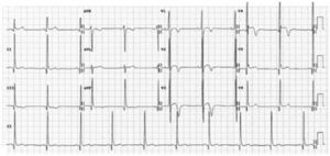 ECG of healthy male athlete of African origin, showing increased QRS voltage, convex ST-segment elevation and deep T-wave inversion in V1–V4 (courtesy of Cardiovascular Sciences Research Centre, St. George