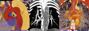 (a) Three-dimensional volume rendering of the thoracic aorta. The ascending aorta is normal, but there is significant tortuosity of the aortic arch and fusiform dilatation of the descending aorta; (b) coronal plane volume rendering reconstruction showing a dilated hemiazygos vein (black arrows) anteriorly crossing the descending aorta; (c) coronal plane volume rendering reconstruction demonstrating the presence of bilateral left bronchi (hyparterial bronchial position). Ao: aorta; LP: left pulmonary artery; RP: right pulmonary artery.