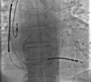 Angiogram showing the successfully repositioned atrial pacing lead.