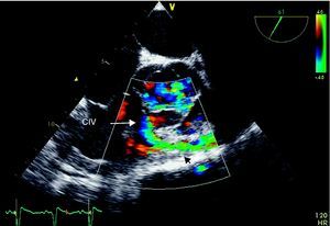 Restrictive subpulmonary ventricular septal defect with jet from the left to the right ventricular outflow tract (arrow) and infundibular pulmonary stenosis (arrowhead) with turbulent flow.