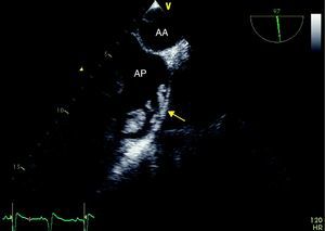 Vegetations (arrows) attached to the pulmonary artery wall. AA: atrial appendage; AP: pulmonary artery.