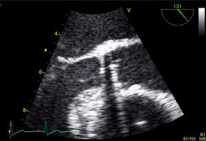 Transesophageal echocardiogram in mid-esophageal long-axis view of the aortic prosthesis. No signs of prosthetic valve endocarditis were visualized at this point.