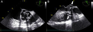 Transesophageal echocardiogram in mid-esophageal short- (A) and long-axis (B) views of the aortic prosthesis, showing two abscesses (A, asterisk) surrounding the single-disc mechanical prosthetic valve (A, cross). There appears to be no rupture from these abscesses (B, white arrow) to the left ventricular outflow tract.