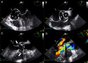 Transesophageal echocardiogram showing multiple abscesses (asterisk) surrounding the single-disc mechanical prosthetic valve (cross). These abscesses had ruptured to the left ventricular outflow tract forming a pseudoaneurysm (white arrow) extending above the aortic valve plane. Severe periprosthetic regurgitation and mild to moderate mitral regurgitation were also noted (D). The images were obtained in mid-esophageal view at 0° (A); short-axis view (B); and long-axis view without (C) and with (D) color flow Doppler.