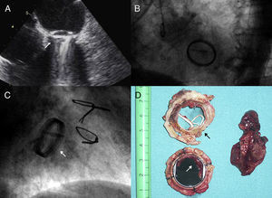 Transesophageal echocardiogram (A) and fluoroscopy (B and C) showing impaired motion of the two leaflets due to associated pannus and thrombosis; (D) explanted mechanical mitral valve. The shape of pannus growth on the ventricular surface of the prosthesis removed from the prosthesis can be clearly seen. The concentric stenosis of the valve orifice area (black arrow) and the thrombosis on the atrial side causing valve blockage (white arrow) are evident. The mural blood clot removed from the left atrial appendage is shown.