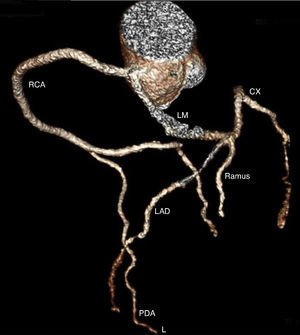 Left and right coronary arteries with a common origin in the right sinus of Valsalva. Cx: circumflex; LAD: left anterior descending; LM: left main; PDA: posterior descending artery; RCA: right coronary artery.