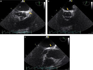 Echocardiogram showing the lesion. AE: left atrium; VE: left ventricle.