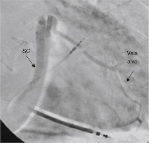 Venography showing the target lateral vein. SC: coronary sinus; Veia alvo: target vein.