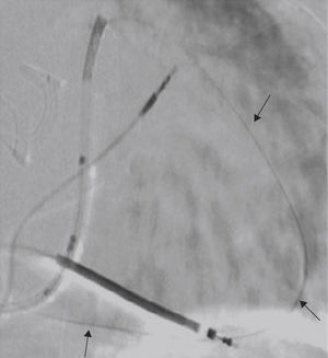 Advancing the guide wire from the lateral vein via a posterior collateral vein up to the coronary sinus ostium (arrows).