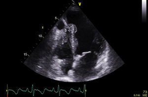 Transthoracic echocardiogram showing a large apical aneurysm of the left ventricle and a pseudoaneurysm in the right ventricle.