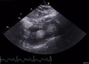 Transthoracic echocardiogram with SonoVue® contrast showing a ventricular septal defect connecting a large apical aneurysm of the left ventricle with a pseudoaneurysm in the right ventricle.
