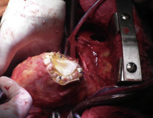 Intraoperative photograph of ventricular septal defect closure and resection of the right ventricular pseudoaneurysm.