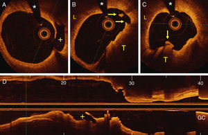 Optical coherence tomography. (A) A ruptured cap and a large posterior cavity (+) are visualized; (B and C) images showing a lipid plaque (L) and a large red thrombus (T) protruding into the coronary lumen (arrows); (D) longitudinal reconstruction highlighting the ruptured plaque cavity (+) in the flow direction. GC: guiding catheter; *: wire artefact.