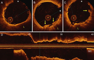 Optical coherence tomography images after intervention. (A) A large residual thin-cap fibroatheroma is partially visualized behind the scaffold; (B and C) a residual thrombus (arrows) protruding slightly into the lumen and a lipid plaque (L) are also visualized; (D) longitudinal image showing a fully expanded scaffold. GC: guiding catheter; *: wire artefact.