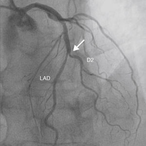 Coronary angiography demonstrating a 90% calcified lesion (arrows) in the mid left anterior descending artery (LAD) involving the second diagonal branch (D2).