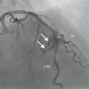 Coronary angiography showing class III perforation (perforation ≥1mm in diameter with contrast streaming or cav- ity spilling) after balloon inflation at high pressure. D2: second diagonal branch; LAD: left anterior descending artery.
